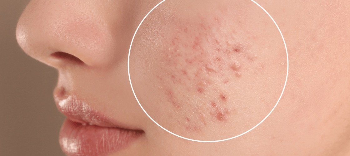 Acne 101 Understanding Different Types, Causes, and Effective Treatments (1)