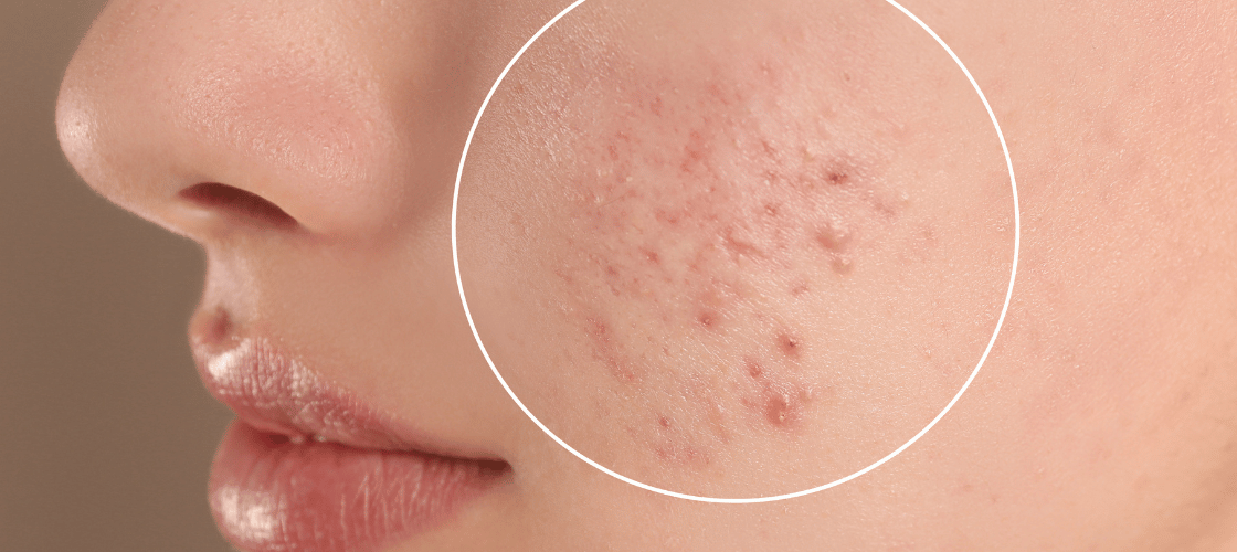 Acne 101 Understanding Different Types, Causes, and Effective Treatments (1)