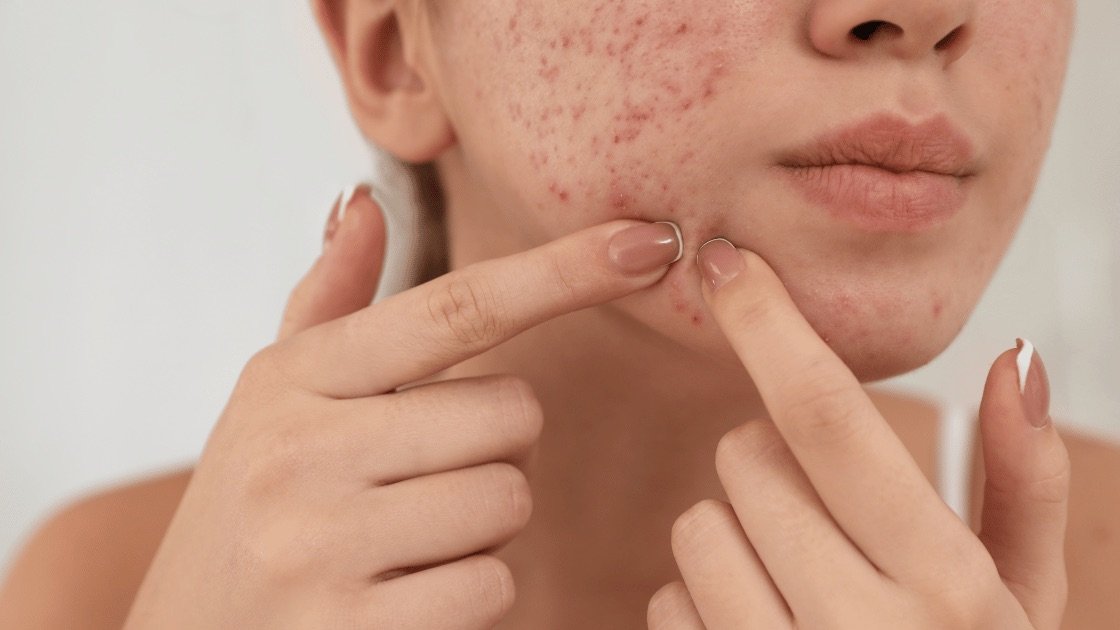 Acne 101 Understanding Different Types, Causes, and Effective Treatments