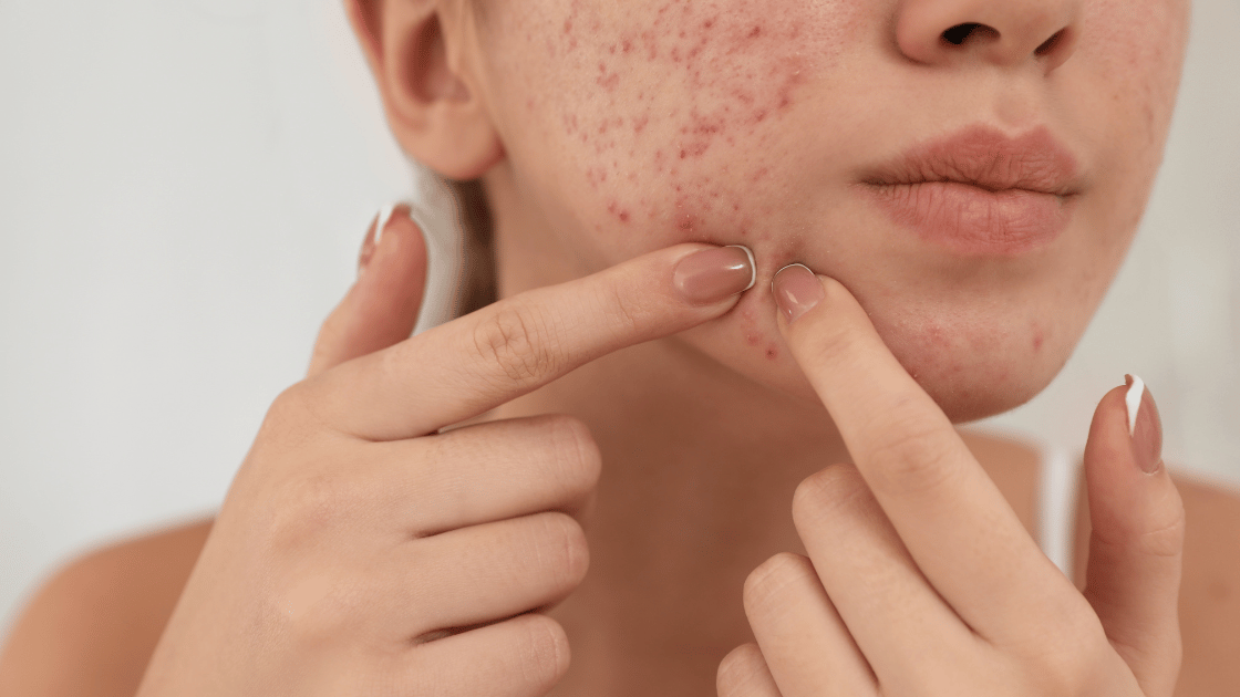 Acne 101 Understanding Different Types, Causes, and Effective Treatments