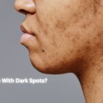 How to Remove Dark Circles Naturally at Home