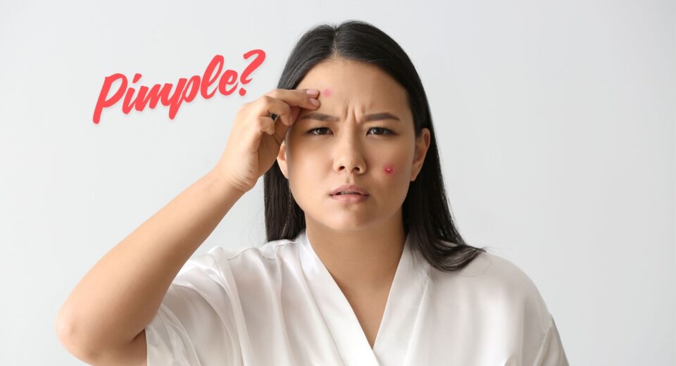 Pimple